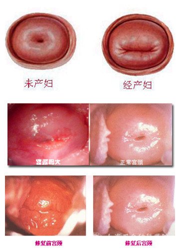 宫颈肥大症状图片